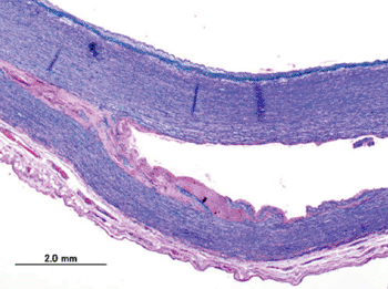 Image: Histopathology of dissecting aneurysm of thoracic aorta (Photo courtesy of Wikimedia).